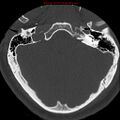 Occipital condyle fracture (Radiopaedia 18366-18208 Axial bone window 1).jpg