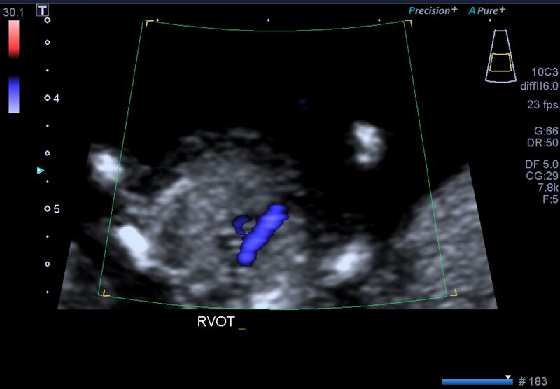 File:1st trimester nuchal-morphology ultrasound (Radiopaedia 44706-48477 General anatomy and NT 24).jpg