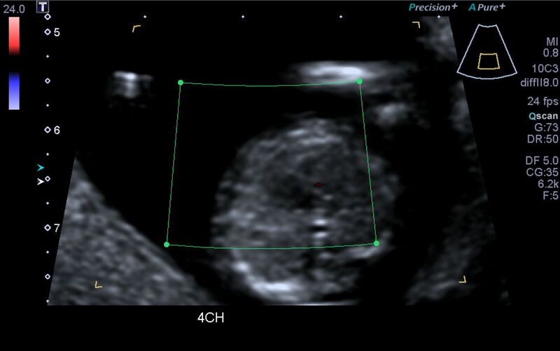 File:1st trimester nuchal-morphology ultrasound (Radiopaedia 44706-48477 Heart views cine with colour 16).jpg