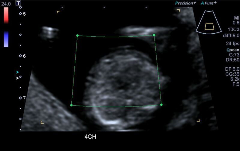 File:1st trimester nuchal-morphology ultrasound (Radiopaedia 44706-48477 Heart views cine with colour 37).jpg