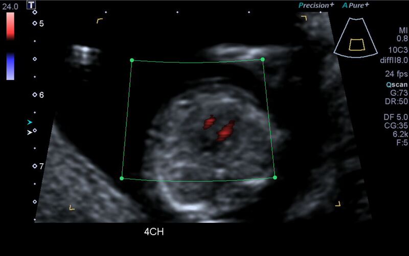 File:1st trimester nuchal-morphology ultrasound (Radiopaedia 44706-48477 Heart views cine with colour 39).jpg