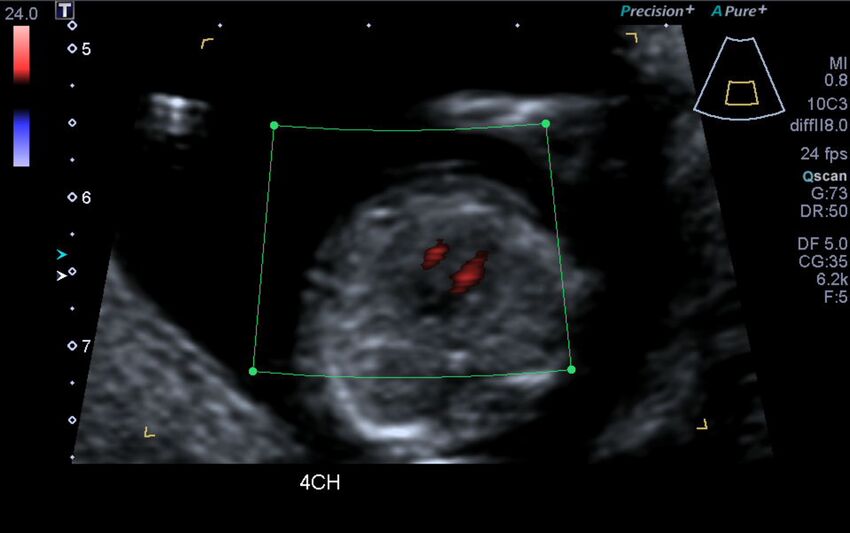 1st trimester nuchal-morphology ultrasound (Radiopaedia 44706-48477 Heart views cine with colour 39).jpg
