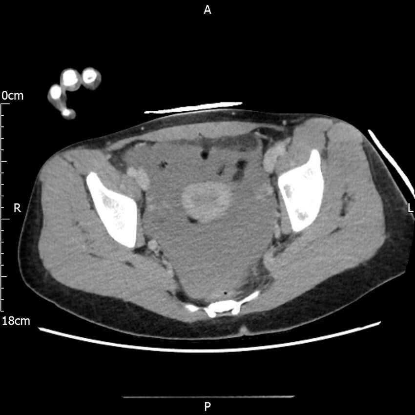 AAST grade IV kidney injury with CEUS follow-up (Radiopaedia 72353-82877 Axial C+ portal venous phase 68).jpg