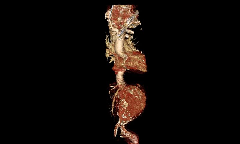 File:Abdominal aortic aneurysm- extremely large, ruptured (Radiopaedia 19882-19921 3D 1).jpg