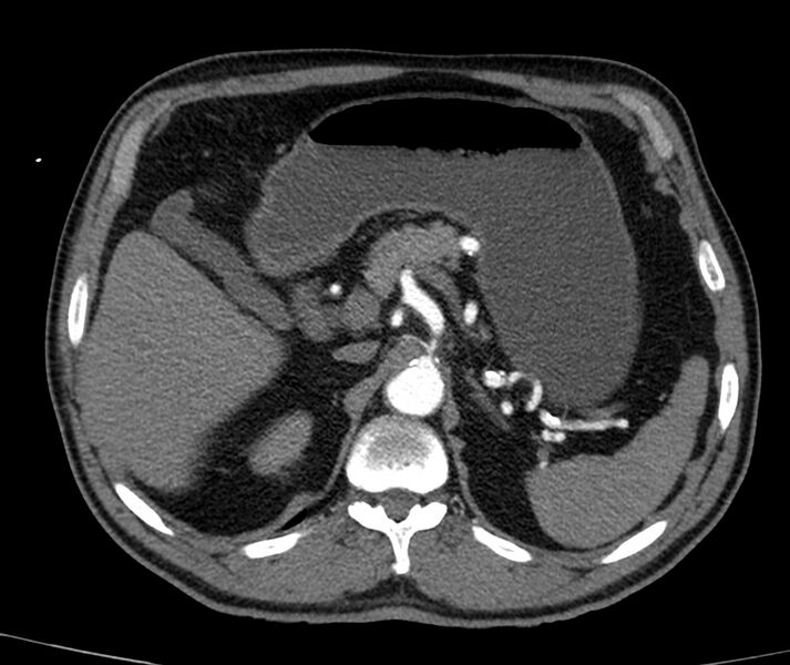 File:Abdominal aortic aneurysm (Radiopaedia 22421-22458 C+ arterial phase 14).jpg