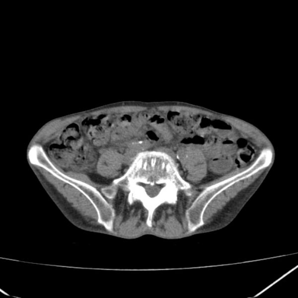File:Abdominal aortic aneurysm (Radiopaedia 23703-23856 Axial non-contrast 37).jpg