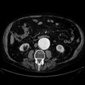 Abdominal aortic aneurysm (Radiopaedia 25855-26001 Axial C+ arterial phase 66).jpg