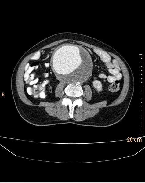 File:Abdominal aortic aneurysm (Radiopaedia 25985-26121 Axial C+ arterial phase 21).jpg