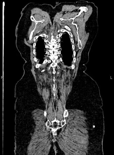 File:Abdominal aortic aneurysm (Radiopaedia 85063-100606 Coronal C+ arterial phase 57).jpg