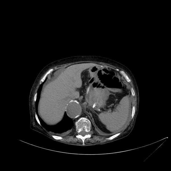 File:Abdominal aortic aneurysm - impending rupture (Radiopaedia 19233-19246 Axial non-contrast 28).jpg