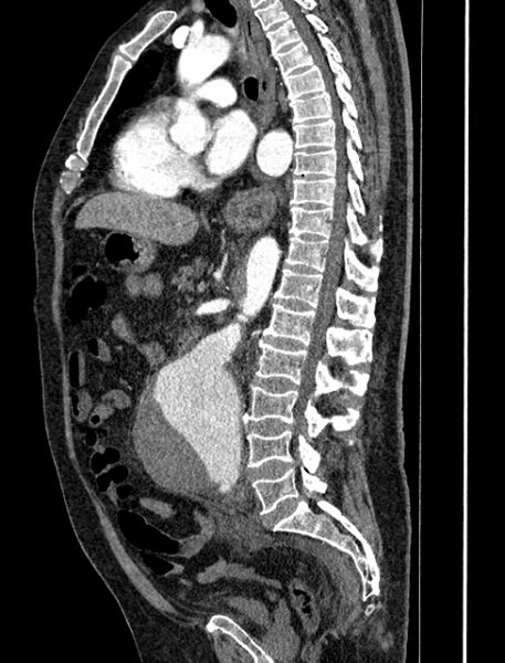 File:Abdominal aortic aneurysm rupture (Radiopaedia 54179-60362 Sagittal C+ arterial phase 21).jpg