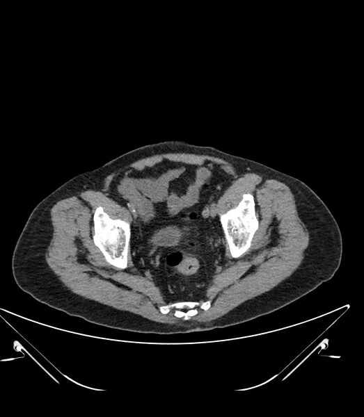 File:Abdominal aortic aneurysm with thrombus fissuration (Radiopaedia 46218-50618 Axial non-contrast 51).jpg