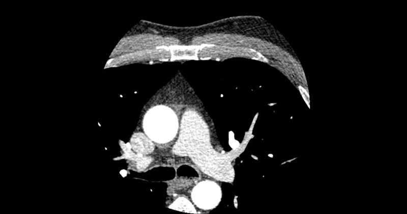 File:Aberrant left main coronary artery (ALMCA) arising from the right sinus with interarterial course (Radiopaedia 63251-71814 Axial C+ arterial phase 8).JPG