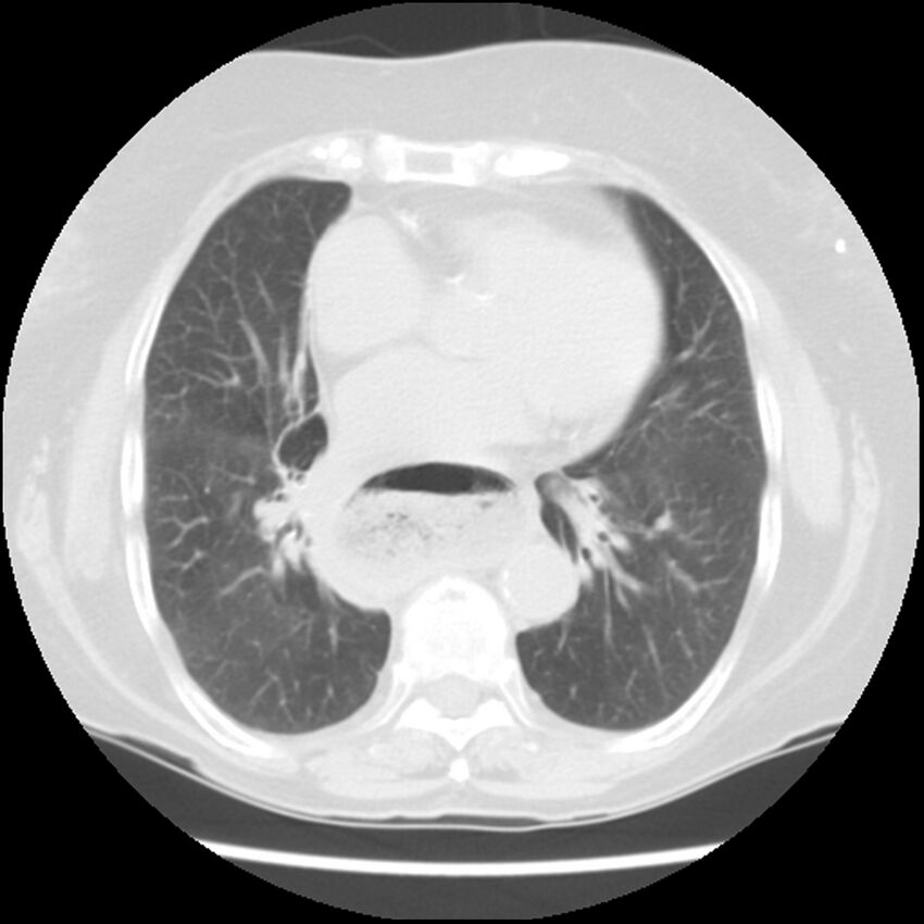 Achalasia (Radiopaedia 44094-47649 Axial lung window 35).jpg