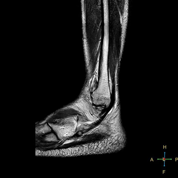 File:Achilles tendon complete tear (Radiopaedia 22834-22854 Sagittal T2 2).jpg