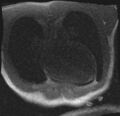 Active right ventricular cardiac sarcoidosis (Radiopaedia 55596-62100 Axial Dynamic perfusion scan MOCO 1).jpg