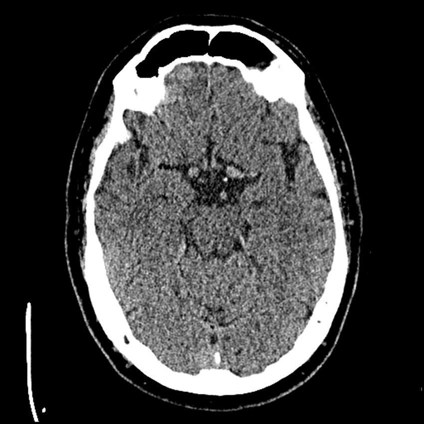 Acute A3 occlusion with ACA ischemic penumbra (CT perfusion) (Radiopaedia 72036-82525 Axial non-contrast thins 4).jpg