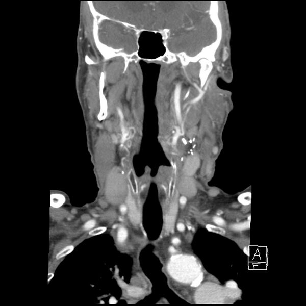 File:Acute ICA ischemic penumbra due to high-grade CCA stenosis (CT perfusion) (Radiopaedia 72038-82530 Coronal C+ arterial phase 17).jpg