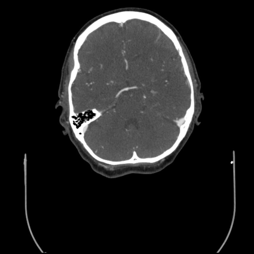 Acute M1 occlusion with ischemic penumbra (CT perfusion) (Radiopaedia 71897-82344 Axial C+ arterial phase thins 84).jpg