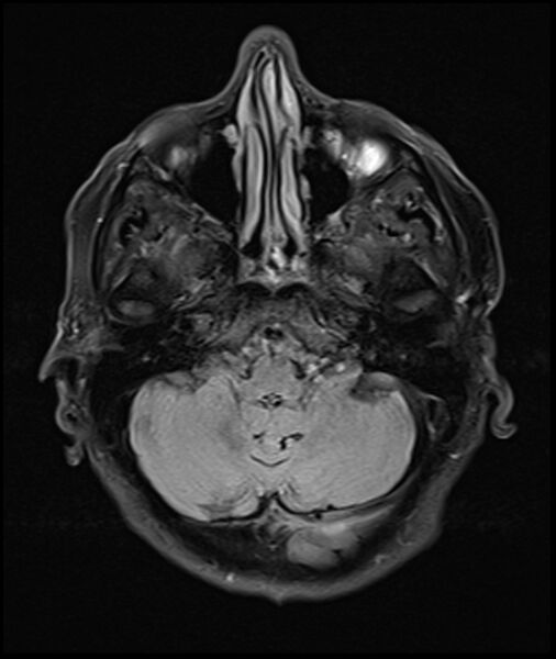 File:Acute P1 occlusion with PCA ischemia penumbra (CT perfusion) (Radiopaedia 72084-82590 Axial FLAIR 7).jpg