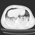 Acute aspiration pneumonitis (Radiopaedia 33605-34703 Axial lung window 70).jpg