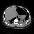Acute aspiration pneumonitis (Radiopaedia 33605-34703 Axial non-contrast 71).jpg