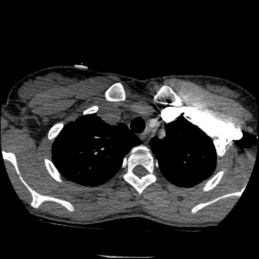 Acute chest syndrome - sickle cell disease (Radiopaedia 42375-45499 Axial C+ CTPA 35).jpg