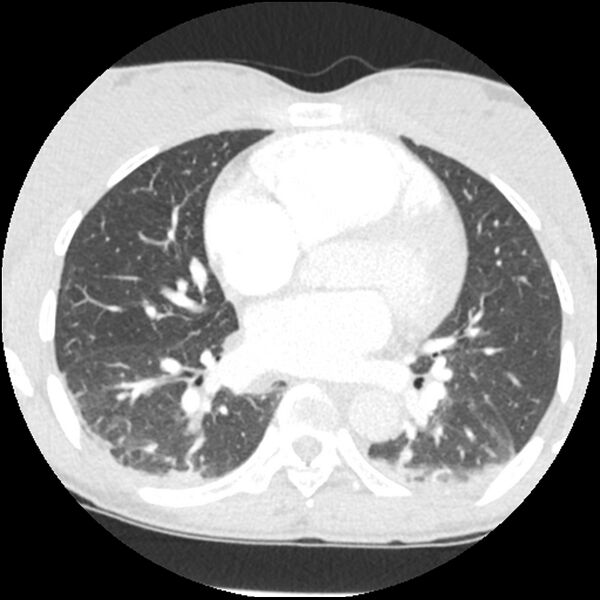 File:Acute chest syndrome - sickle cell disease (Radiopaedia 42375-45499 Axial lung window 107).jpg