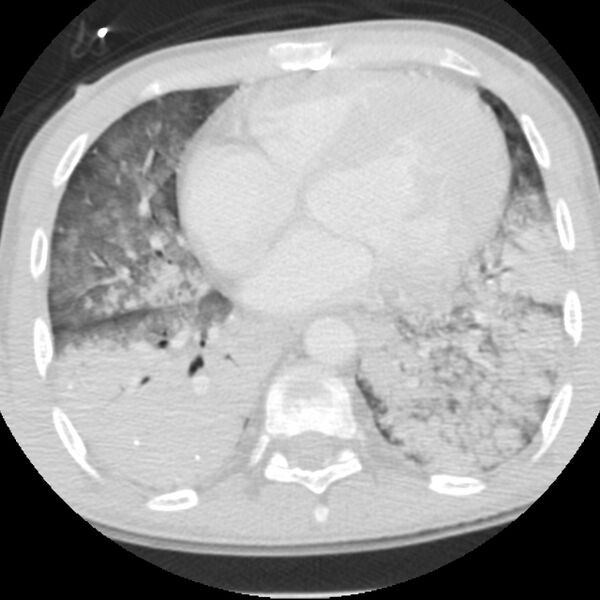 File:Acute diffuse alveolar hemorrhage (Radiopaedia 41323-44158 Axial lung window 39).jpg