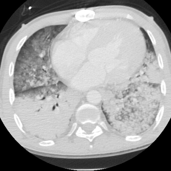 File:Acute diffuse alveolar hemorrhage (Radiopaedia 41323-44158 Axial lung window 40).jpg