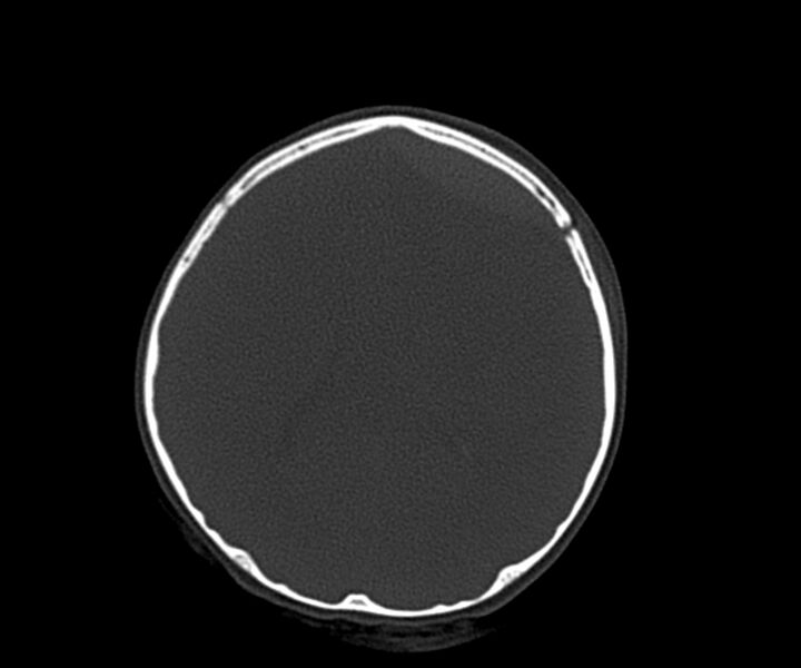 File:Acute epidural hematoma (Radiopaedia 63659-72335 Axial bone window 20).jpg