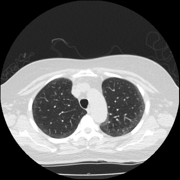 File:Acute interstitial pneumonitis (Radiopaedia 45404-49444 Axial lung window 27).jpg