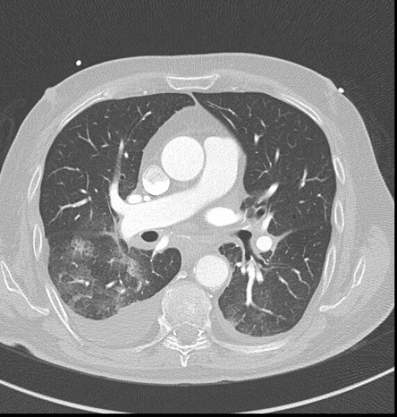 File:Acute myocardial infarction (Radiopaedia 23413-23481 lung window 25).jpg