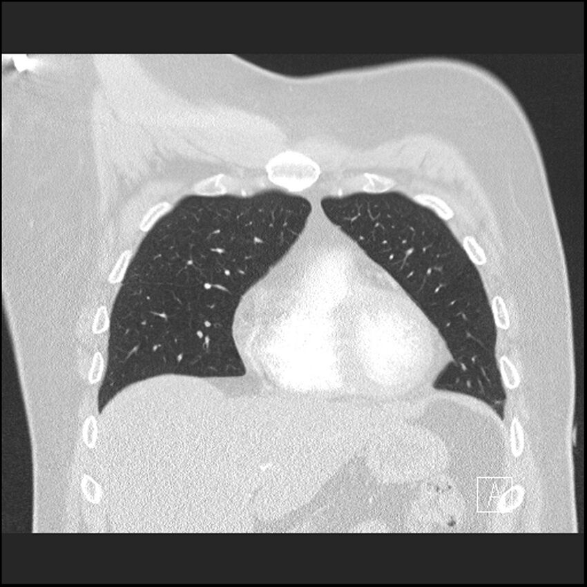 Acute pulmonary embolism with pulmonary infarct (Radiopaedia 73062-83768 Coronal lung window 20).jpg