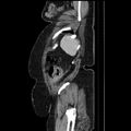 Acute pyelonephritis (Radiopaedia 25657-25837 Sagittal renal parenchymal phase 68).jpg