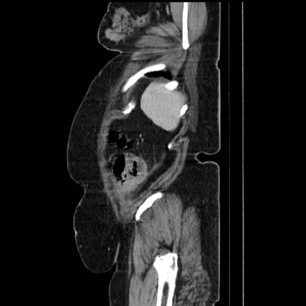 File:Acute pyelonephritis (Radiopaedia 25657-25837 Sagittal renal parenchymal phase 68).jpg
