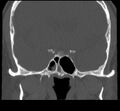 Acute sinusitis (Radiopaedia 23161-23215 Coronal bone window 51).jpg