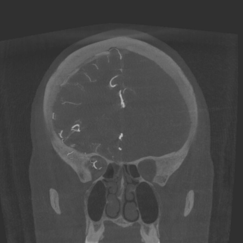 Acute subarachnoid hemorrhage and accessory anterior cerebral artery (Radiopaedia 69231-79010 Coronal arterial - MIP 30).jpg