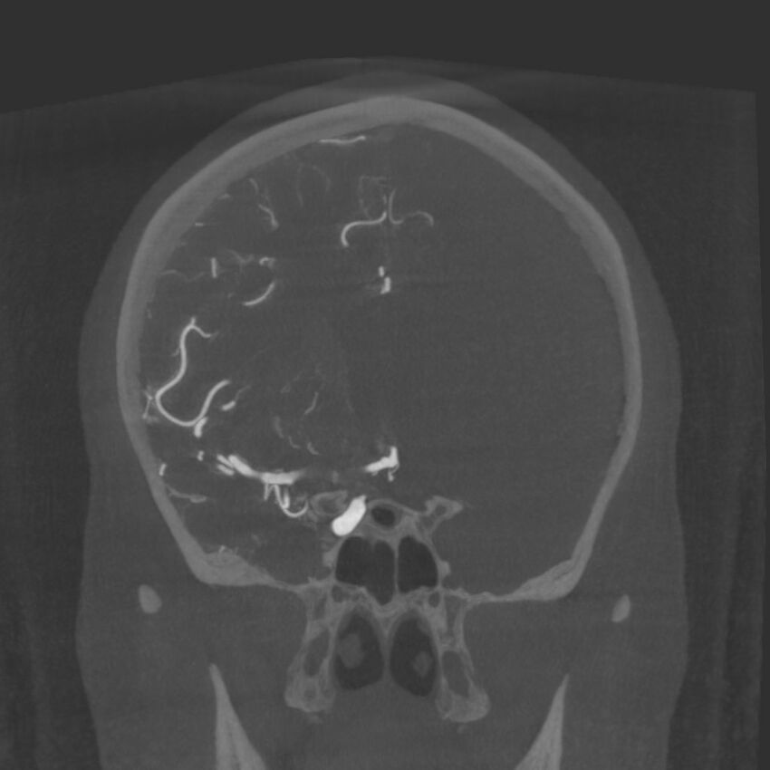 Acute subarachnoid hemorrhage and accessory anterior cerebral artery (Radiopaedia 69231-79010 Coronal arterial - MIP 40).jpg