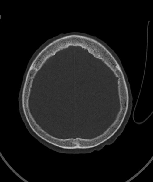 File:Acute traumatic subdural hematoma (Radiopaedia 82921-97257 Axial bone window 28).jpg