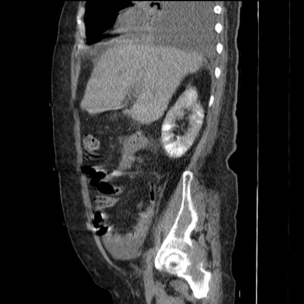 File:Acute tubular necrosis (Radiopaedia 28077-28334 Sagittal non-contrast 30).jpg