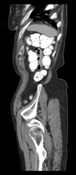 File:Adenocarcinoma of cecum (Radiopaedia 59222-66549 Sagittal C+ portal venous phase 2).jpg