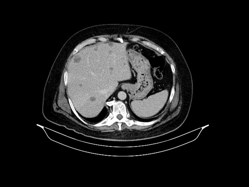File:Adenocarcinoma of pancreas with hepatic metastasis (Radiopaedia 64332-73122 Axial C+ delayed 21).jpg