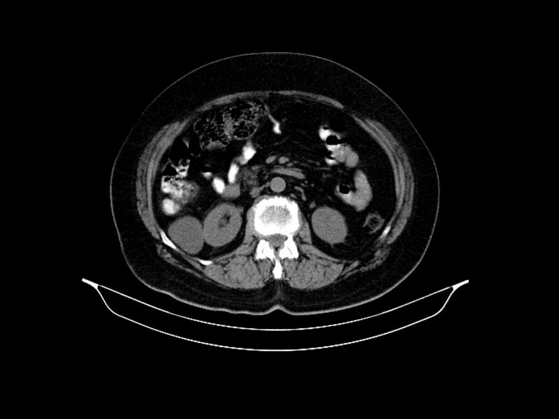 File:Adenocarcinoma of pancreas with hepatic metastasis (Radiopaedia 64332-73122 Axial non-contrast 47).jpg