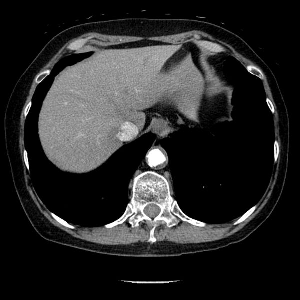 File:Adenocarcinoma of the lung (Radiopaedia 41015-43755 Axial C+ portal venous phase 105).jpg