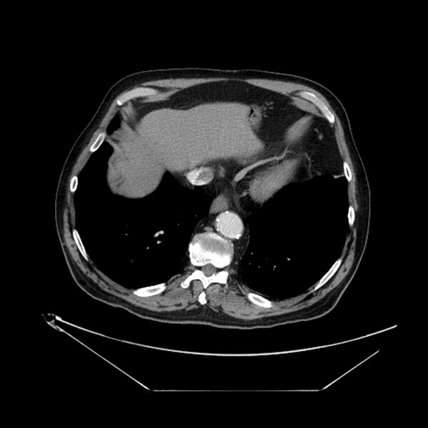 File:Adenocarcinoma of the lung (Radiopaedia 44876-48759 Axial C+ portal venous phase 67).jpg