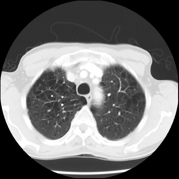 File:Adenocarcinoma of the lung - micropapillary predominant (Radiopaedia 42446-45563 Axial lung window 16).jpg