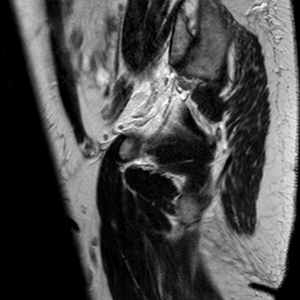 File:Adenomyoma of the uterus (Radiopaedia 9871-10439 Sagittal T2 24).jpg