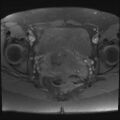 Adenomyosis and endometriotic cysts (Radiopaedia 82300-96367 Axial T1 fat sat 8).jpg