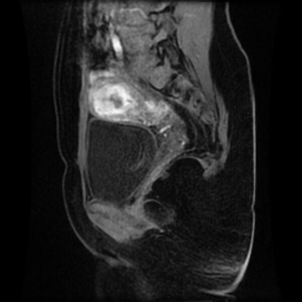 File:Adenomyosis within a septate uterus (Radiopaedia 69963-79981 Sagittal LAVA-Dyn 11).jpg